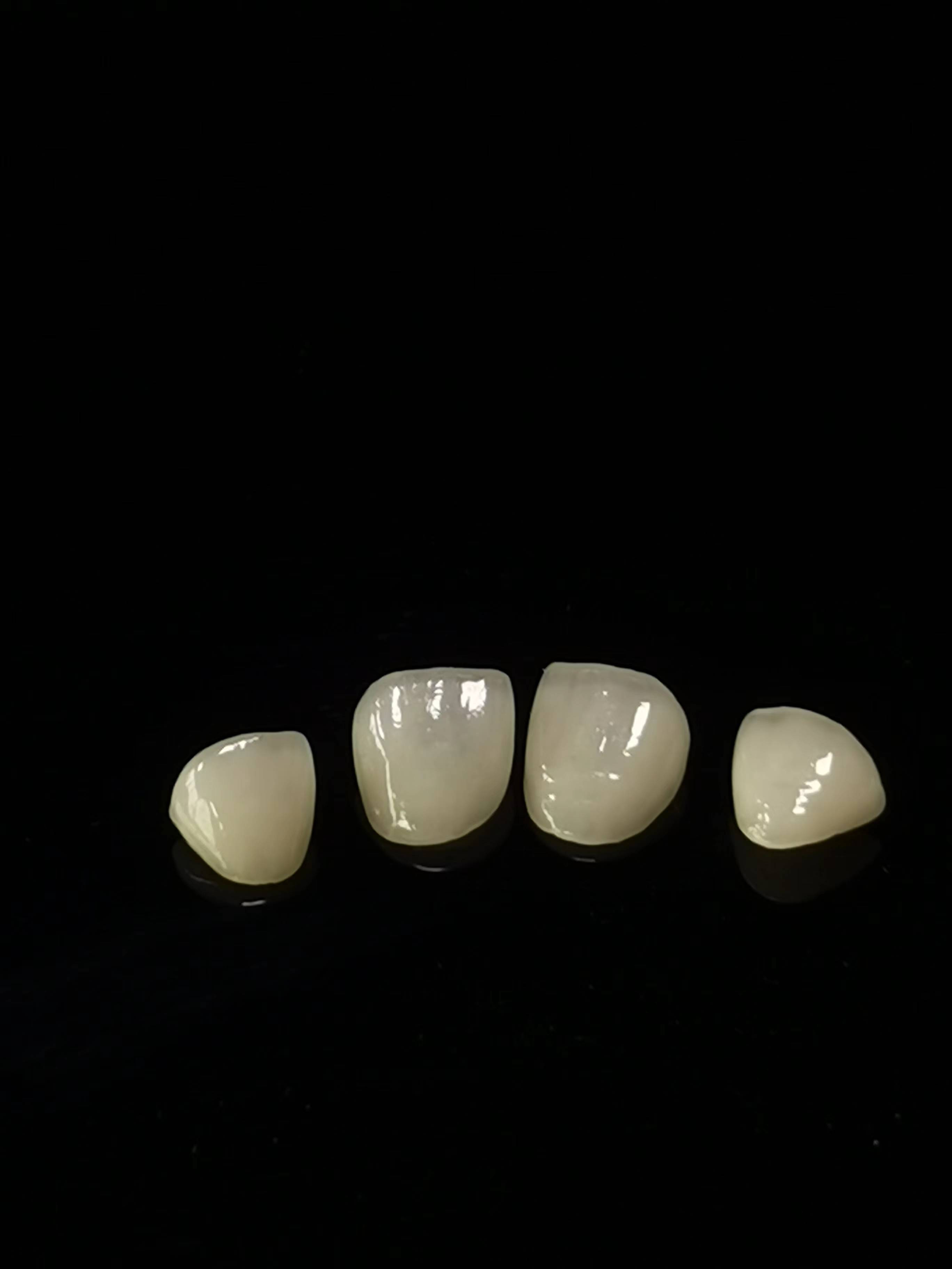 E.max Dental lab Arbeid