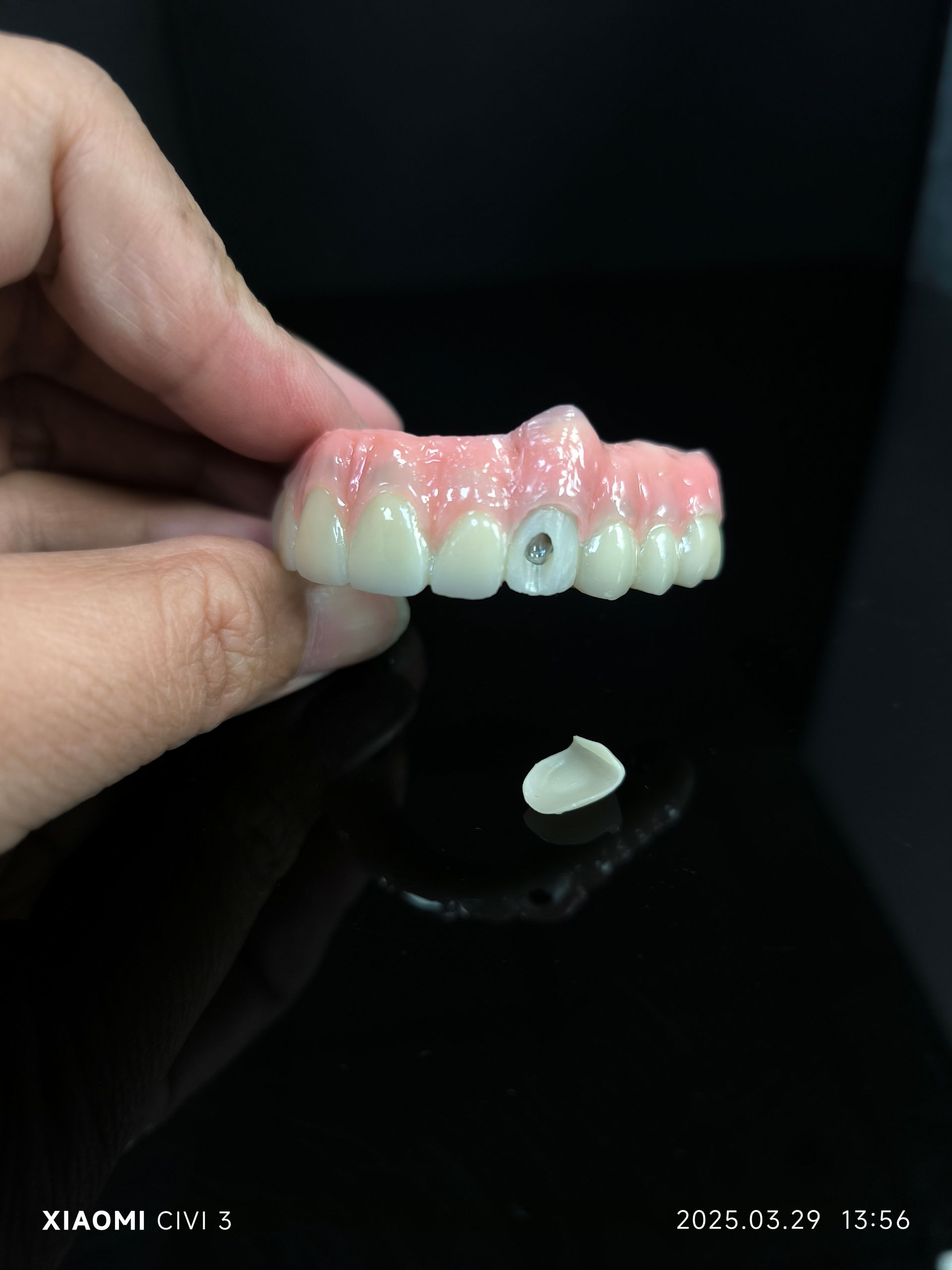 Alt på 4 - Hybrid Zirconia Bridge -løsning for vestibulært skruehull