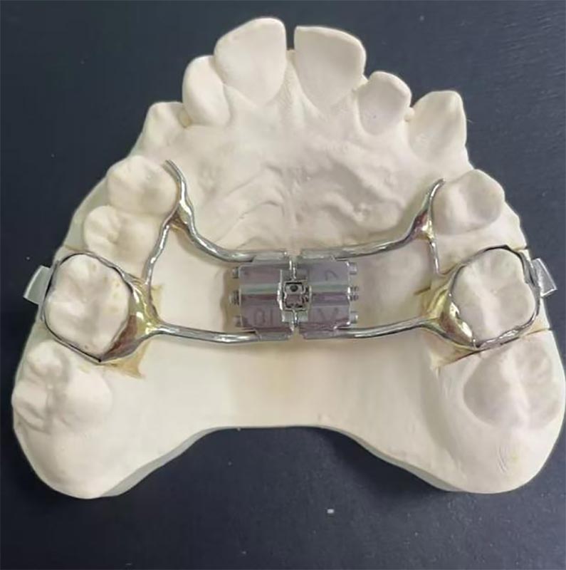 Hva er en rask maxillary expander (RME)?