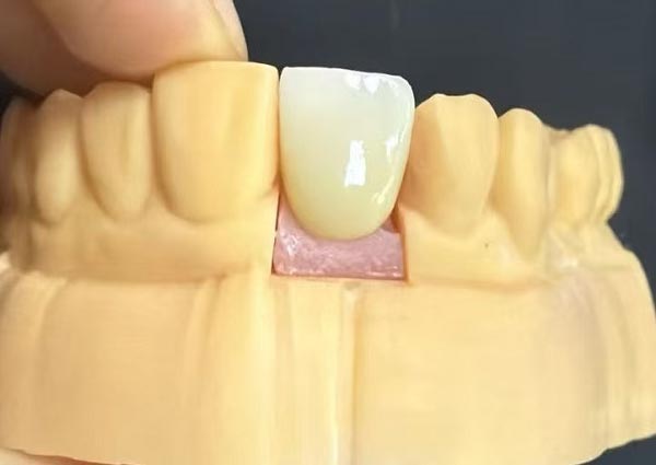 Avstander mellom tennene kan fikses – rette tenner er de mest attraktive!