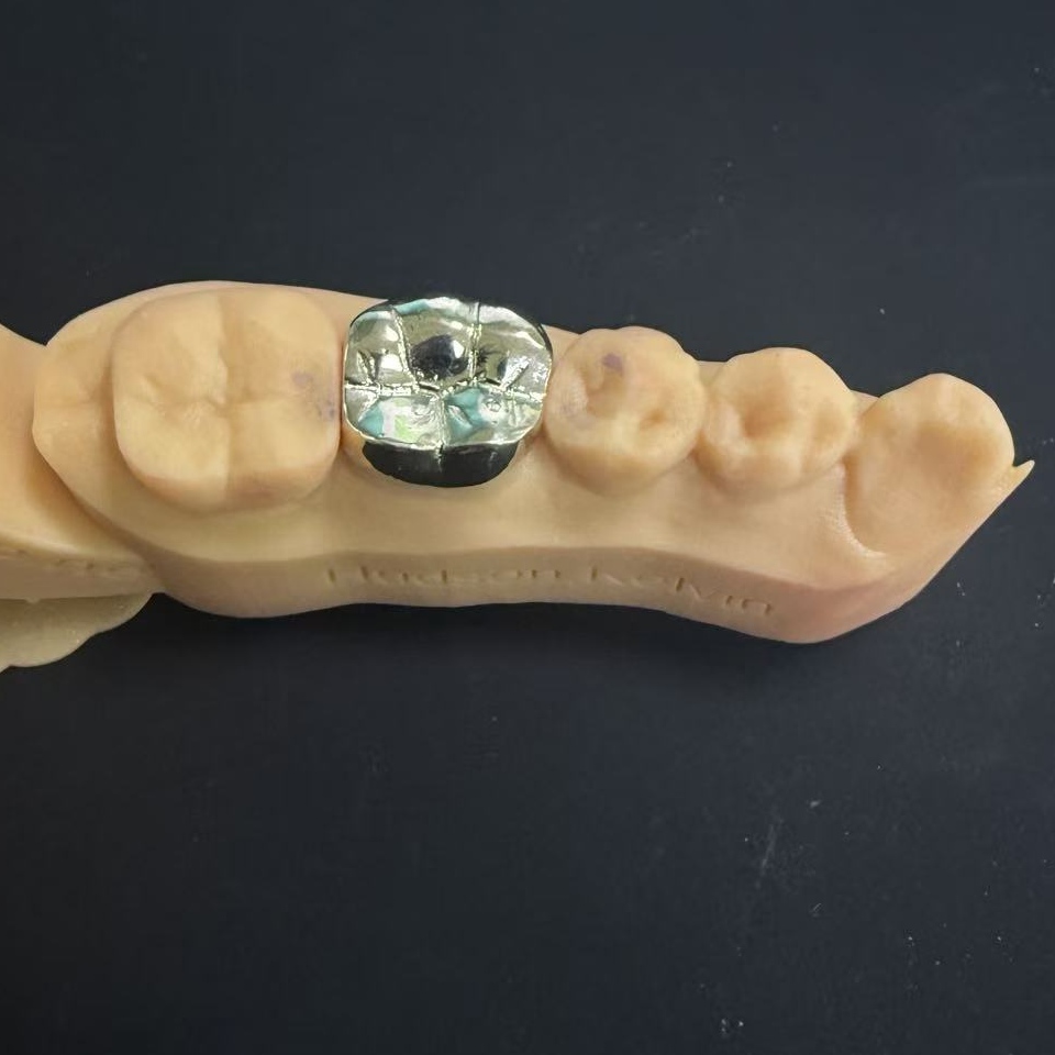 Gullkroner: edelmetallvalget for livslang tannrestaurering