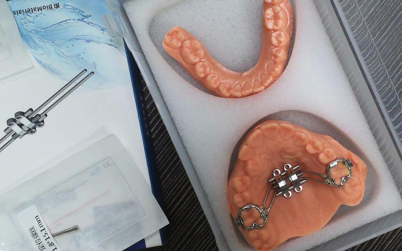 Forstå MSE-skjelettutvidelse med WM Dental Lab