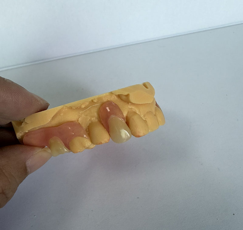 Valplast Partials ved WM Dental Lab