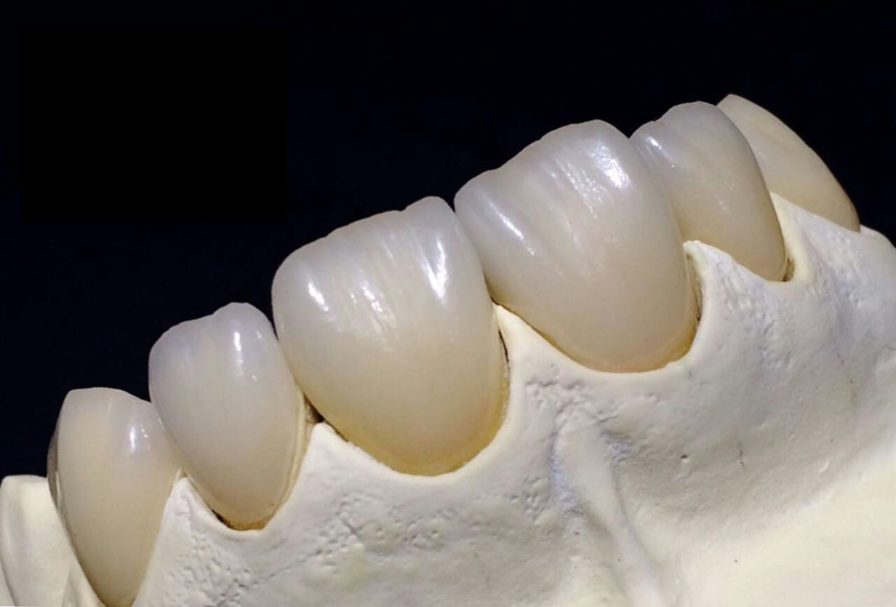 Full Zirconia Crown Kina tannlegelaboratorium
