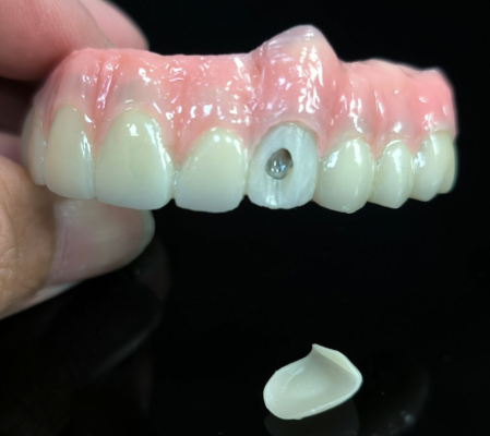 Alt på 4 Hybrid - Hybrid Zirconia Bridge -løsning for vestibulært skruehull