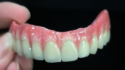 Alt på 4 Hybrid - Malo Bridge Full Zirconia Kroner over titanstruktur