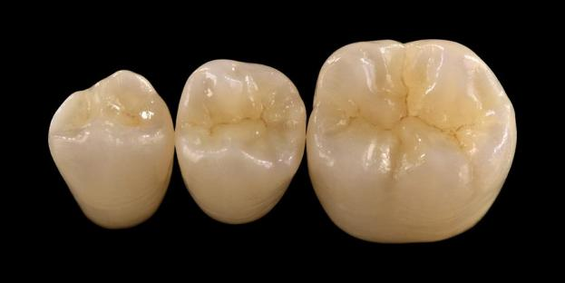 <h2>Zirconia i odontologi: indikasjoner, fordeler og kliniske hensyn</h2>
<p>Zirconia er anerkjent for sin styrke og holdbarhet. De siste generasjonene av zirkoniummaterialer tilbyr også betydelig forbedrede estetiske egenskaper. For pasienter som vurderer helkeramiske restaureringer, er det viktig å nøye evaluere både indikasjonene og begrensningene til zirkoniumoksidbaserte systemer.</p>
<p>Dagens pasienter forventer i økende grad restaureringer som kombinerer utmerket estetikk med full funksjonell ytelse. De fleste moderne keramiske systemer kan oppfylle disse forventningene, men klinisk suksess avhenger i stor grad av riktig materialvalg, tannpreparering og sementeringsprotokoller. Valget bør styres av viktige materialegenskaper som bruddmotstand, bøyestyrke, slitestyrke og langsiktig stabilitet. Blant disse materialene har zirkoniumoksid blitt et av de mest brukte alternativene i moderne restaurerende tannbehandling.</p>
<h3>Hvorfor velge Zirconia?</h3>
<p>Zirconia er verdsatt for sin eksepsjonelle styrke og langsiktige holdbarhet. Moderne zirconia er betydelig forskjellig fra tidligere generasjoner, som var mer ugjennomsiktige og mindre estetiske. I dag muliggjør CAD/CAM-teknologi presis fabrikasjon av zirconia-restaureringer med forbedrede optiske egenskaper.</p>
<p>Restaureringer kan utformes som:</p>
<ul>
<li><strong>Monolittisk zirkonium:</strong>Ideell for bakre kroner og broer, og tilbyr høy styrke og holdbarhet.</li>
<li><strong>Lagdelt zirkonium:</strong>Egnet for tilfeller som krever forbedret estetikk, inkludert langvarige restaureringer på tvers av forskjellige områder av munnen.</li>
</ul>
<p>Bøyestyrken varierer avhengig av typen, fra ca. 590 MPa i zirkoniumoksid med høy gjennomskinnelighet til opptil 1400 MPa i monolittiske former. Zirconia restaureringer kan sementeres med selvklebende harpikssementer eller harpiksmodifiserte glassionomersementer.</p>
<h3>Nøkkelfaktorer i materialvalg av Zirconia</h3>
<p>Når de vurderer zirkoniumoksid for en helkeramisk restaurering, bør klinikere vurdere flere kritiske faktorer:</p>
<ul>
<li>Gjenværende tannstruktur</li>
<li>Plassering i munnhulen (estetisk sone vs funksjonell sone)</li>
<li>Tilstedeværelse av parafunksjonelle vaner som bruksisme</li>
<li>Gjennomskinnelighet av tilstøtende naturlige tenner</li>
<li>Farge og tilstand på underliggende tannstruktur</li>
</ul>
<p>Den estetiske sonen inkluderer vanligvis de fremre tennene, selv om den hos noen pasienter kan strekke seg til første molar avhengig av smilelinjen og ansiktsdynamikken. Den funksjonelle sonen inkluderer generelt premolarer og molarer, hvor okklusale krefter er betydelig høyere.</p>
<h3>Funksjonell soneapplikasjoner</h3>
<p>I bakre regioner må okklusale krefter vurderes nøye. Zirconia er et utmerket alternativ til tradisjonelle PFM-restaureringer, spesielt i tilfeller med begrenset restaureringsplass. Moderne monolittisk zirconia tillater full-kontur design av okklusal anatomi, inkludert funksjonelle cusps og marginale rygger, samtidig som den opprettholder høy styrke.</p>
<p>Gjeldende bevis viser at monolittisk zirkonium er godt egnet for bakre kroner og broer med flere enheter på grunn av sin utmerkede motstand mot brudd og slitasje. Fremskritt innen limteknikker og preparatdesign har også forbedret langsiktige kliniske resultater.</p>
<h3>Applikasjoner for estetiske soner</h3>
<p>I den fremre regionen må restaureringer tett gjenskape naturlig tannfarge, gjennomskinnelighet og lysadferd. Mens materialer som litiumdisilikat tilbyr utmerket estetikk, er de mindre sterke og krever vanligvis liming.</p>
<p>En viktig fordel med zirconia er dens evne til å bli konvensjonelt sementert samtidig som den oppnår høy estetisk ytelse. Med utviklingen av høygjennomskinnelige og flerlags zirkoniumsystemer, er det nå mulig å produsere restaureringer som tett etterligner naturlig tannsett.</p>
<p>Avanserte prosesseringsteknikker forbedrer de optiske egenskapene ytterligere og reduserer ufullkommenheter som kan påvirke lystransmisjon og utseende.</p>
<h3>Styrke og estetikk kombinert</h3>
<p>Tidlige zirkoniumsystemer prioriterte styrke, men manglet estetisk kvalitet. Moderne monolitisk zirconia kombinerer med suksess både styrke og forbedret utseende, noe som gjør den egnet for et bredt spekter av kliniske tilfeller.</p>
<p>Det er spesielt gunstig for pasienter med parafunksjonelle vaner eller tidligere restaureringssvikt. Kliniske studier indikerer høy pasientaksept og lav komplikasjonsrate.</p>
<p>Bekymringer om slitasje på motsatt tannsett har blitt redusert med nyere formuleringer. Høypolerte zirkonium-overflater viser lavt slipepotensial, og kan i noen tilfeller være skånsommere enn tradisjonelle porselen-smeltet-til-metall-restaureringer.</p>
<h3>Zirconia-implantater: fremvoksende alternativ</h3>
<p>Mens titanimplantater fortsatt er den kliniske standarden, får zirkoniumimplantater oppmerksomhet som et metallfritt alternativ. Tidlige design var først og fremst systemer i ett stykke, men todelte zirkonium-implantater tillater nå forbedret protesefleksibilitet.</p>
<p>Zirconia-implantater er spesielt nyttige i tilfeller der estetiske bekymringer eksisterer, for eksempel potensiell grå misfarging av peri-implantatvev eller tynn gingival biotype. De kan også vurderes for pasienter med sjelden titanfølsomhet.</p>
<p>Zirkonium-implantater er imidlertid fortsatt relativt nye, og langsiktige kliniske data er fortsatt begrenset sammenlignet med titansystemer.</p>
<h3>Konklusjon</h3>
<p>Zirconia har utviklet seg til et svært allsidig materiale innen restaurerende tannbehandling, og tilbyr en sterk balanse mellom mekanisk ytelse og estetikk. Riktig valg av tilfelle og overholdelse av kliniske protokoller er avgjørende for å oppnå optimale resultater i både fremre og bakre applikasjoner.</p>